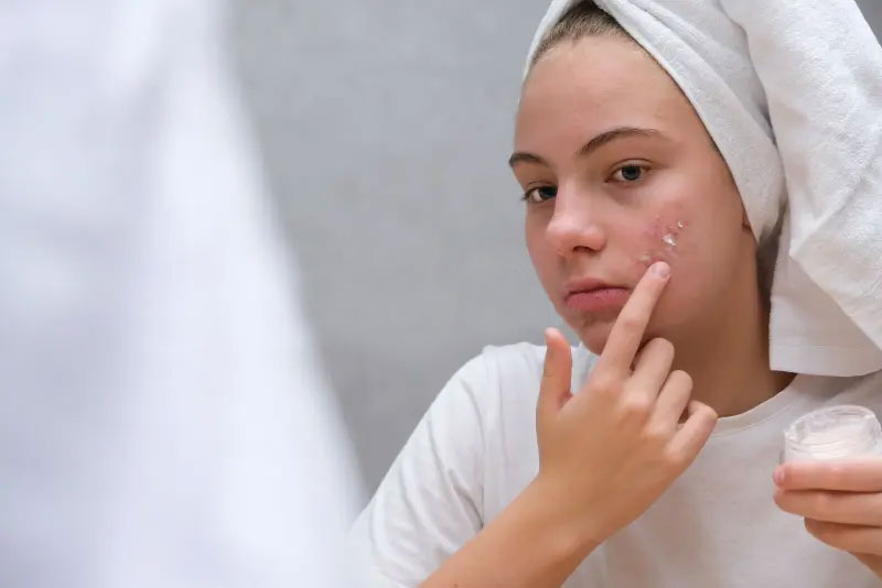 4 Worst Habits That Can Make Acne Worse